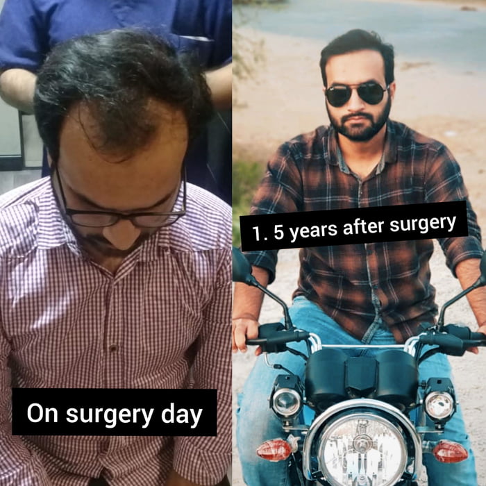 1/12/2018 vs 10/11/2019 (FUE hair transplant) Ask me anything about the process