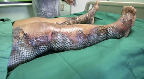 Certain fish skin can be grafted onto burns and diabetic wounds. The material recruits the body's own cells and is converted eventually into living tissue.