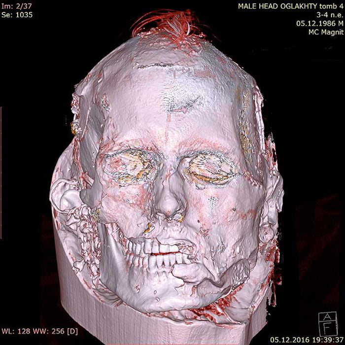 CT scan reveals face with scars and stitches of 1700-year-old Tashtyk man behind his gypsum death mask