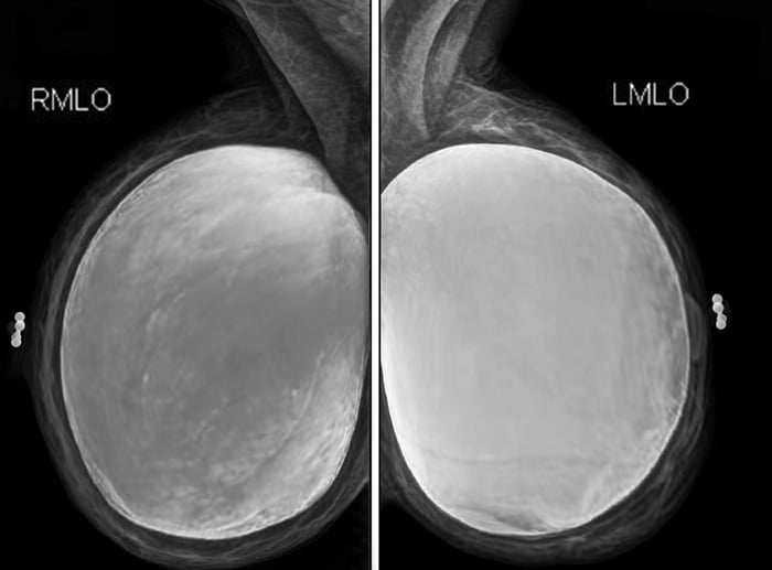 In case you have ever wondered what two 4400cc(thats over 20lbs worth of silicone gel) implants looks like heres one of my old mammograms