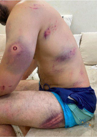 This is how the body of a demonstrator, detained at peaceful protests in Belarus, looks.